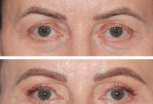 Upper and Lower Eyelid Surgery