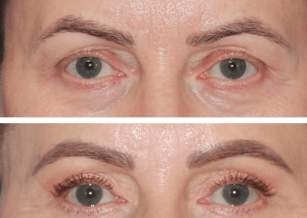 Upper and Lower Eyelid Surgery