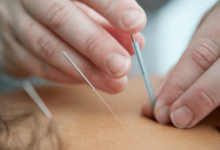 Acupuncture Services