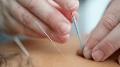 Acupuncture Services