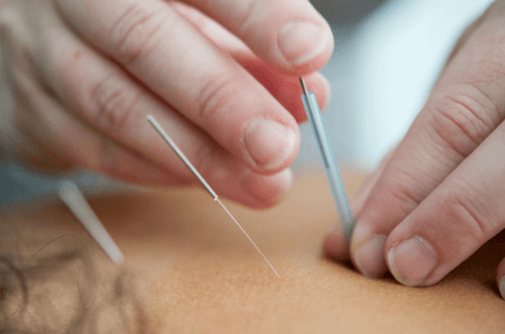 Acupuncture Services